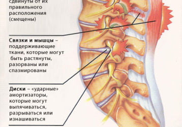 Домашнее лечение поясничного остеохондроза: эффективные способы