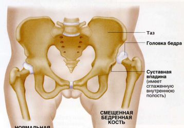 Вывих тазобедренного сустава: симптомы и лечение