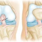 Разрыв передней крестообразной связки колена: причины, симптомы и методы лечения