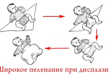Основные техники пеленания при дисплазии тазобедренных суставов у новорожденных