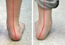 Плоско — вальгусная деформация стоп у детей: лечение, причины, симптомы