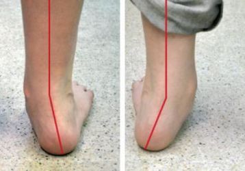 Плоско — вальгусная деформация стоп у детей: лечение, причины, симптомы