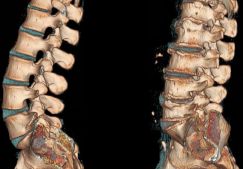 Питание и диета при остеохондрозе позвоночника, полезные и вредные продукты