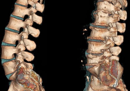 Народные рецепты с лимоном и чесноком для домашнего лечения остеохондроза