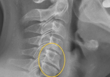 Боли в области сердца при остеохондрозе: кардиологические симптомы