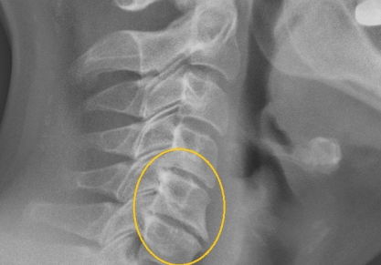 Остеохондроз шейного отдела 3 степени: медикаментозные и хирургические методы лечения