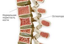 Симптомы эффективное лечение остеопороза позвоночника, диагностика заболевания