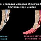 Основные причины смещения копчика, методы диагностики и лечения
