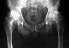 Двухсторонний коксартроз 1-2 степени: диагностика и лечение
