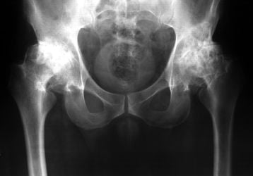 Двухсторонний коксартроз 1-2 степени: диагностика и лечение