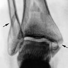 Посттравматический артроз голеностопного сустава: симптомы и лечение
