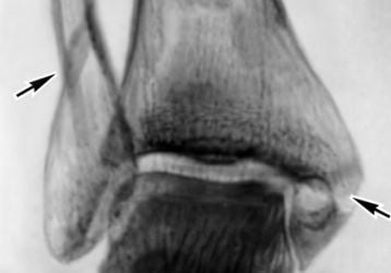 Посттравматический артроз голеностопного сустава: симптомы и лечение