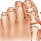 Лечение бурсита большого пальца стопы медикаментами, мазями и хирургически