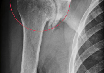 Лечение хондроза плечевого сустава медикаментами, массажем, народными средствами