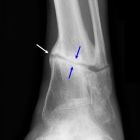 Ложный сустав или псевдоартроз: описание, причины развития, лечение
