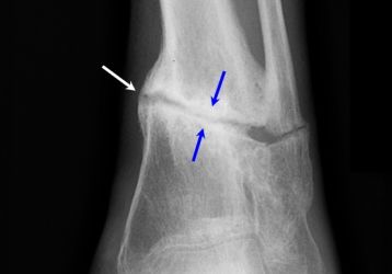Ложный сустав или псевдоартроз: описание, причины развития, лечение