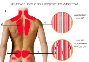 Что такое миозит мышц: причины, основные признаки и методы лечения