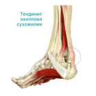 Тендинит ахиллова сухожилия: симптомы и лечение