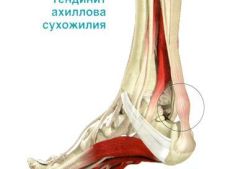 Тендинит ахиллова сухожилия: симптомы и лечение