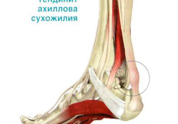 Тендинит ахиллова сухожилия: симптомы и лечение