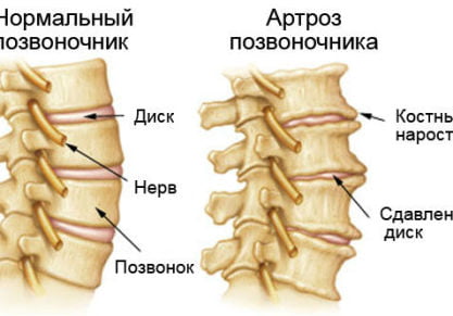 Артроз позвоночника: виды, симптомы и лечение