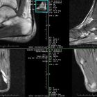 Визуализирующие возможности МРТ голеностопного сустава и стопы