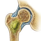 Лечение остеомиелита: что ждет пациента