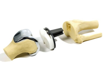 Выбираем эндопротез коленного сустава: срок службы, материалы, цены