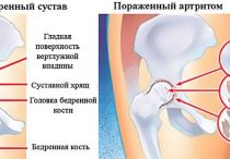 Артрит тазобедренного сустава: симптомы и лечение у детей и взрослых, полное описание болезни