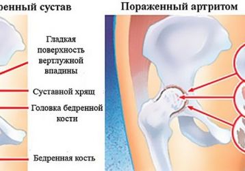 Артрит тазобедренного сустава: симптомы и лечение у детей и взрослых, полное описание болезни