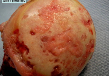 Артроз плечевого сустава — полное описание заболевания, симптомы и эффективные методы лечения