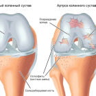 Упражнения при артрозе коленного сустава по методике Бубновского