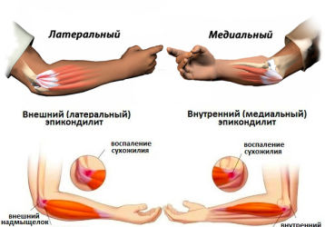 Хруст в локтевом суставе при разгибании — причины и способы лечения