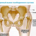 Врожденный вывих тазобедренного сустава у детей и взрослых: лечение и профилактика