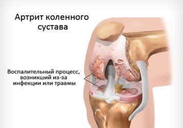 Артрит коленного сустава 1 и 2 степени: признаки и симптомы, способы лечения