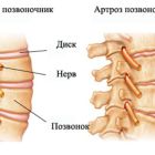 Остеоартроз позвоночника шейного и поясничного отделов