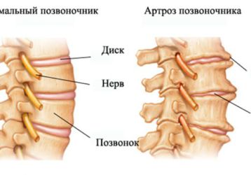 Остеоартроз позвоночника шейного и поясничного отделов
