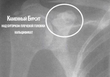 Что такое бурсит плечевого сустава и как его лечить