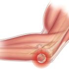 Эпикондилит