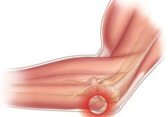 Эпикондилит