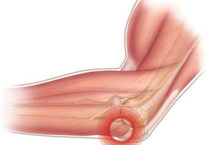 Эпикондилит