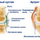 Болезни суставов: как называются, симптомы и лечение заболеваний