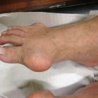 Отложение соли в суставах: что нужно знать о микрокристаллических артропатиях