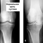 Лучшие хондропротекторы при артрозе коленного сустава и других: классификация, цены