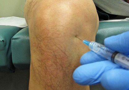 Пункция коленного сустава: техника выполнения и необходимость