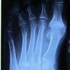 Лечение артроза стопы в домашних условиях: медикаменты, ЛФК, народная медицина