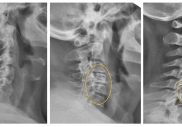 Упражнения при шейном остеохондрозе по методике Гитта Виталия Демьяновича