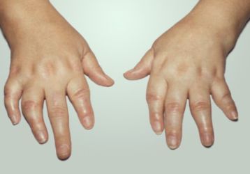 Ювенильный идиопатический артрит у детей: диагностика и лечение