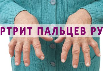 Чем эффективно лечить артрит кистей рук?