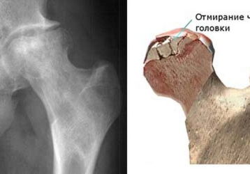 Асептический некроз головки бедренной кости: причины, симптомы, лечение